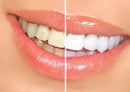 Bright White Smiles 44% Teeth Whitening Gel Syringe Refill Pack, Carbamide Peroxide, 5 Syringes (3ml),Tooth Whitener Formula by CozyNest Decor