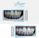 LaserGlow Professional Teeth Whitening Gel 44% Hydrogen Peroxide – Dual Barrel Syringe for Fast, Effective, and Whitening Results | Hydrogen Peroxide Gel, Teeth Whitener, Tooth Whitening Gel by CozyNest Decor