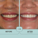 Prostrips - 12 Shades Whiter Teeth - 28 Enamel Safe REMINERALIZING Gentle Strips – 97% no Sensitivity by CozyNest Decor