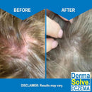 Eczema Shampoo & Conditioner (Combo Pack) - Flare Control Scalp & flake Relief Therapy that Protects, Moisturizes, and Repairs Skin by DermaSolve - Kids & Adults - Steroid Free by TinyTreasures Baby Boutique