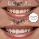 MOON LED Teeth Whitening Kit - Gentle Teeth Whitener Device, 56 White Strips, USB Charger & Travel Case - Blue Light Whitening Tray Removes Stains & Whitens Up to 12 Shades in 2 Weeks (4 Piece Kit) by CozyNest Decor