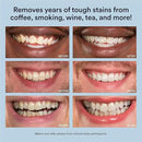 Auraglow Teeth Whitening Kit, LED Accelerator Light, 35% Carbamide Peroxide Teeth Whitening Gel, 20+ Whitening Treatments, Whitens up to 10 Shades in 7 Days by CozyNest Decor