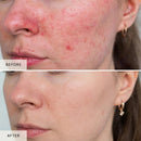 Nicebeam LED Red Light Therapy Face Mask